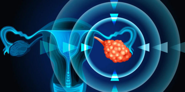 sindrome de ovario poliquistico